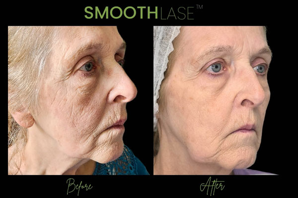 smoothlase before and after