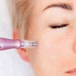 microneedling photo