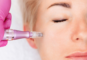 microneedling photo